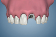 Immediate Implant Placement with Custom Abutment Support